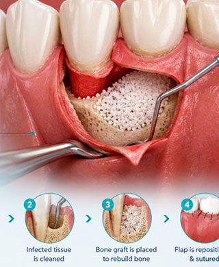 Periodontal Flap Surgeries & Bone Grafting