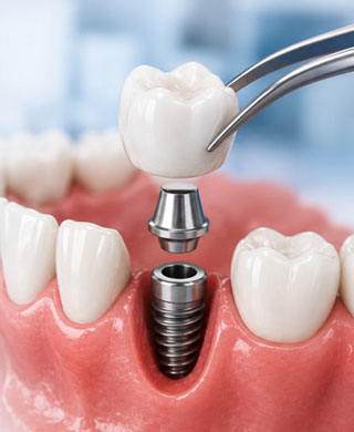 Dental Implants