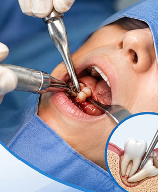 Surgical Tooth Extraction
